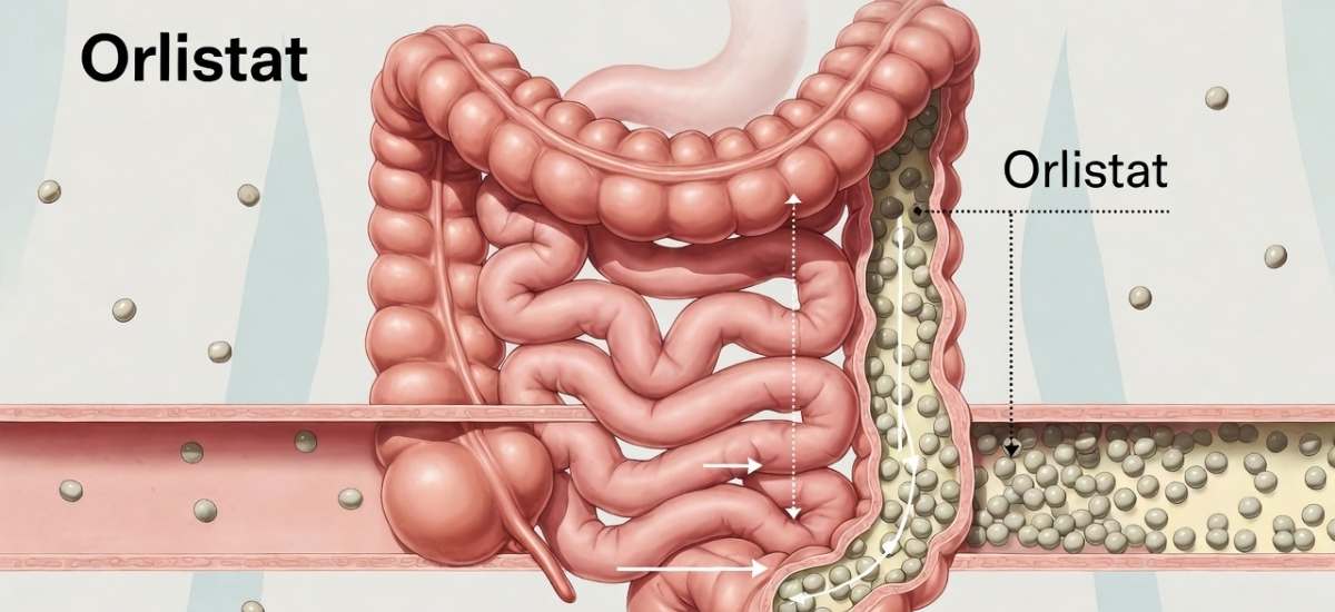 Orlistat para el control del peso: qué conviene saber antes de usarlo
